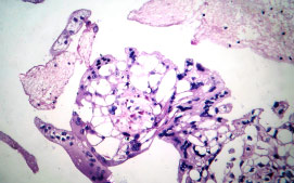  Complete Mole Ectopic Pregnancy 