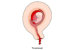 Threatened Miscarriage