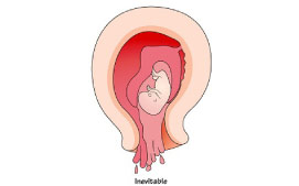 Inevitable Miscarriage
