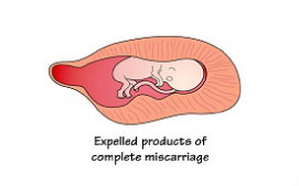 Complete Miscarriage