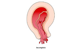Incomplete Miscarriage