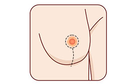 Vertical or Lollipop Lift