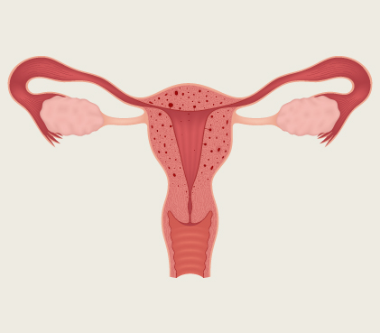 adenomyosis