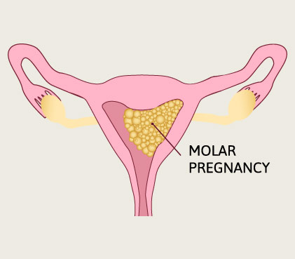 Molar pregnancy image 