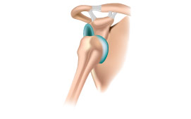 Anterior shoulder dislocation