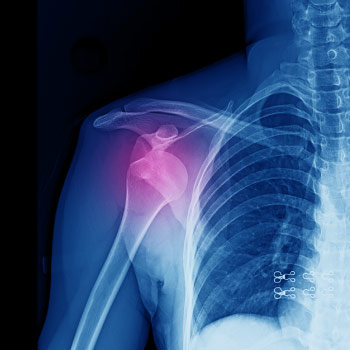 X-Ray of a dislocated shoulder 