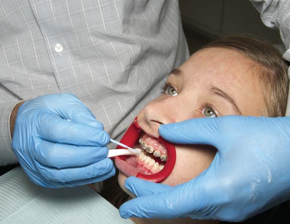 Dental Braces