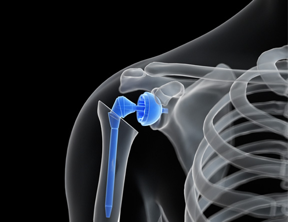 Doctor-performing-Shoulder Replacement-surgery-in-Pune