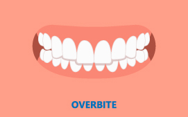 Overbite