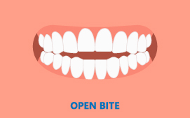 Open Bite