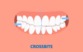 Anterior or posterior crossbite