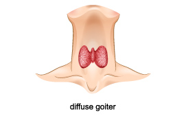 Diffuse goiter - Noncancerous enlargement of the thyroid gland