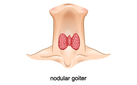 suspicious nodules on the thyroid gland 