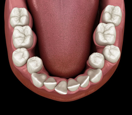 What is malocclusion