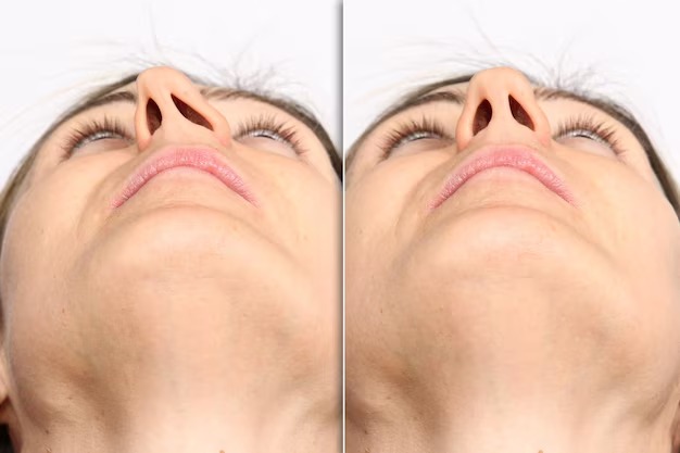 An image showing a deviated nasal septum before and after undergoing a Septoplasty procedure.
