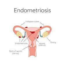 Medical illustration showing endometriosis affecting the ovaries and uterus