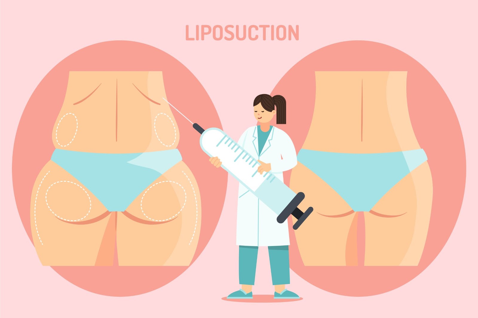 liposuction