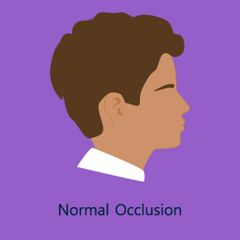 Class II Malocclusion