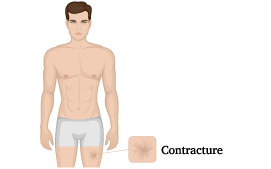 Contracture