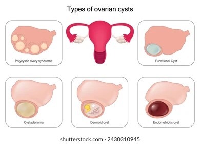 Illustration showing different types of ovarian cysts, including follicular, dermoid, and endometrioma cysts, for medical education and diagnosis