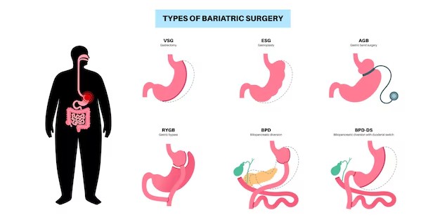different types of bariatric surgery 