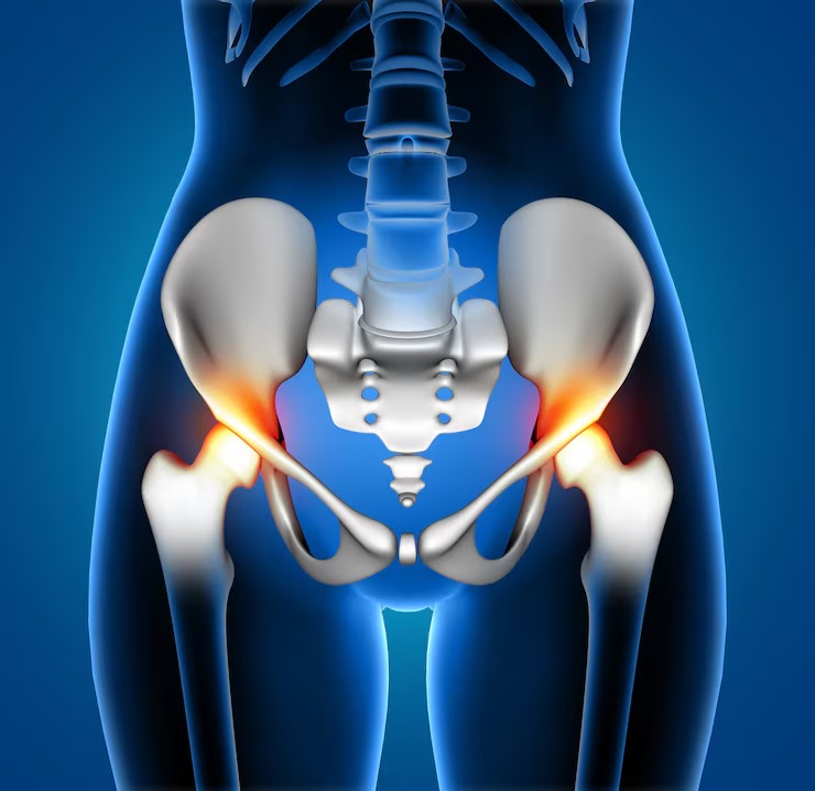An image of an illustration of a hip joint with redness to indicate inflammation.
