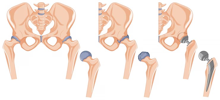  An image representing a hip replacement revision surgery to fix complications with an earlier hip prosthesis.
