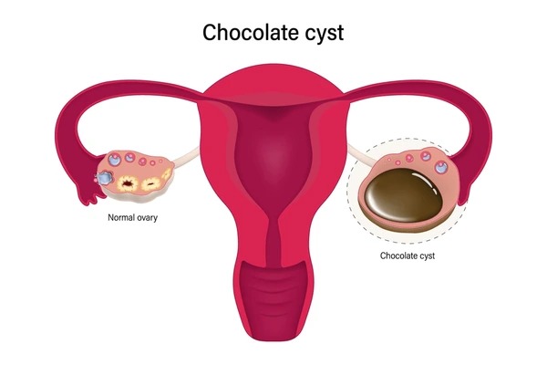  An image of a chocolate cyst inside an ovary, showing thick, dark fluid within the ovarian tissue.