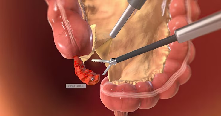 An image of a laparoscopic appendectomy using minimally invasive tools to remove an inflamed appendix in an operating room.