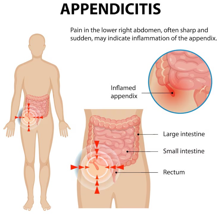 An image of a chart showing appendicitis affecting different sections of the colon with labelled inflammation areas.