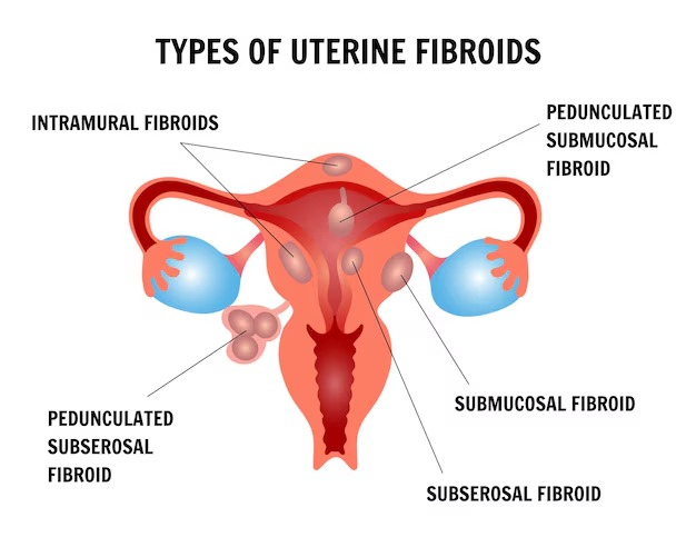An image of a visual representation of common types of uterine fibroids