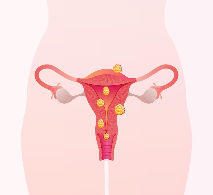 An image of an illustration of a uterus affected by a large fibroid mass.