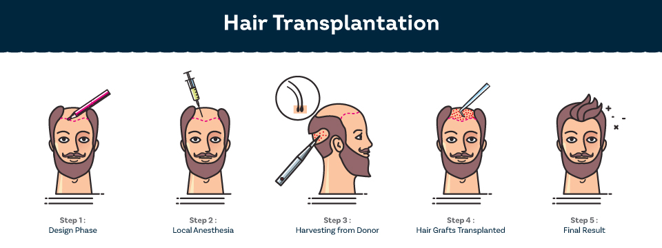 Process of Hair Transplant