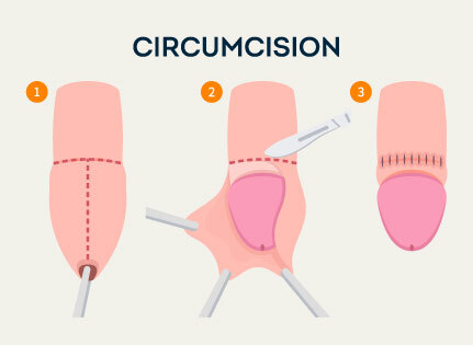 know-more-about-Laser Circumcision-treatment-in-Ambarnath