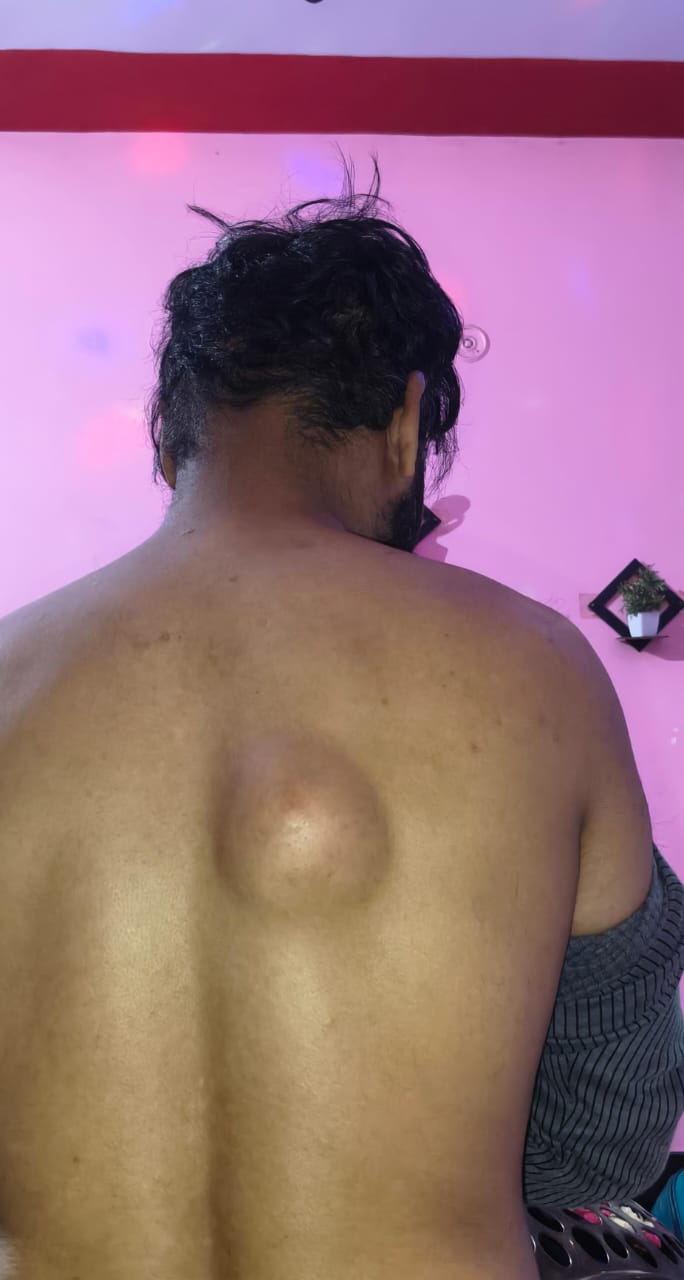 Lipoma on Back