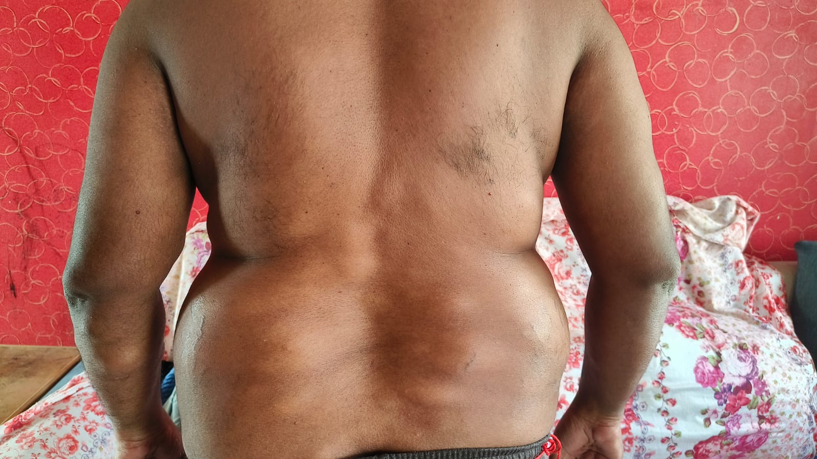 Multiple Lipomas on Back