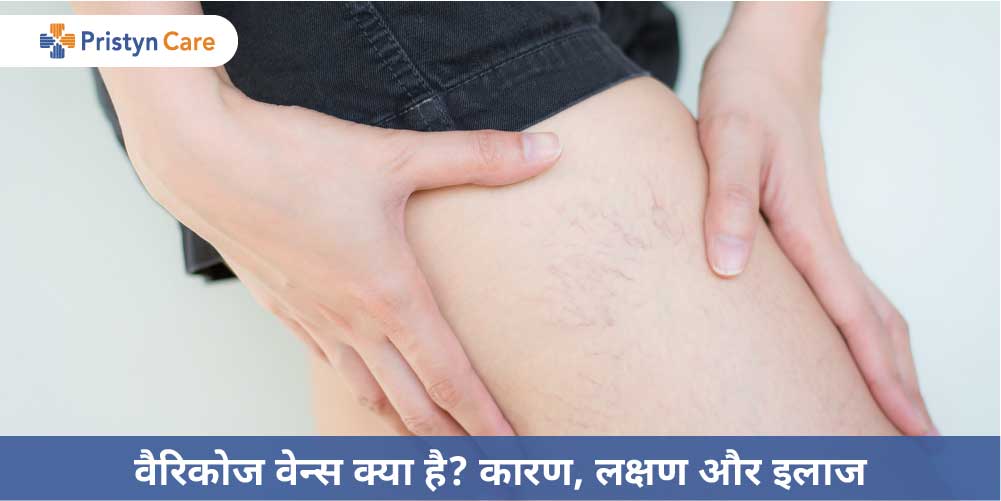 varicose veins in hindi