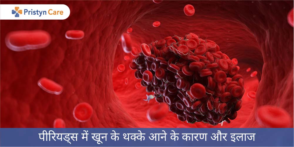 पीरियड्स में खून के थक्के आने के कारण और इलाज (period me blood ka