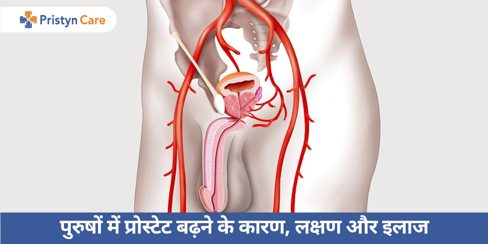 chronic prostatitis symptoms in hindi