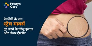 प्रेगनेंसी के बाद स्ट्रेच मार्क्स दूर करने के घरेलू इलाज और लेजर ट्रीटमेंट