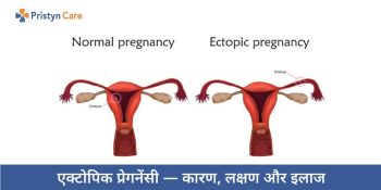 ectopic-pregnancy-ke-karan-lakshan-aur-ilaj