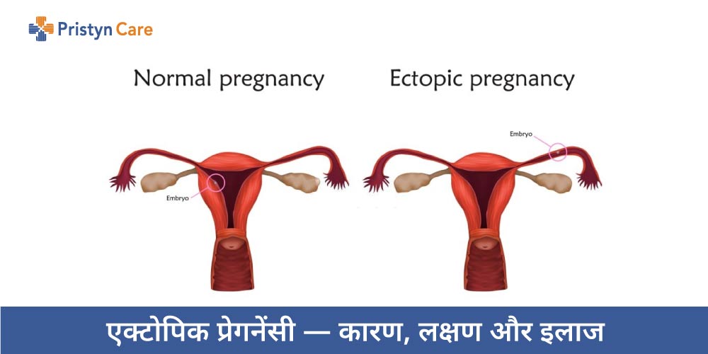 ectopic-pregnancy-ke-karan-lakshan-aur-ilaj