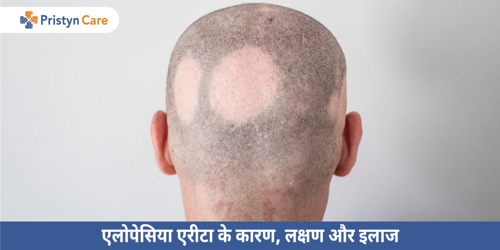 alopecia-ke-kaaran-lakshan-aur-ilaj-in-hindi