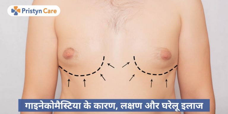 home-remedies-for-gynecomastia-in-hindi