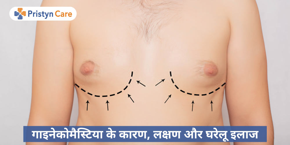 home-remedies-for-gynecomastia-in-hindi