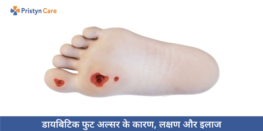 diabetic-foot-ulcer-in-hindi