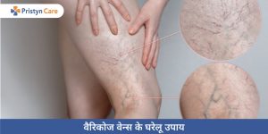 home-remedies-for-varicose-veins-in-hindi