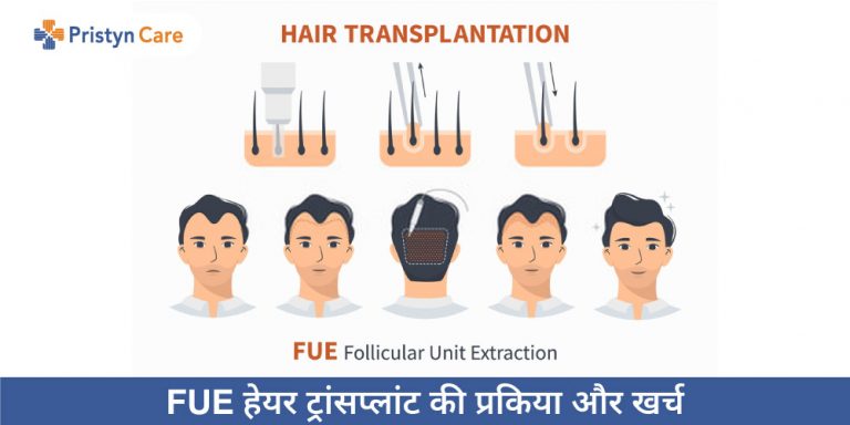 FUE hair transplant in Hindi