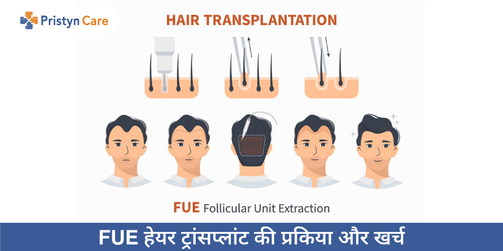 FUE hair transplant in Hindi