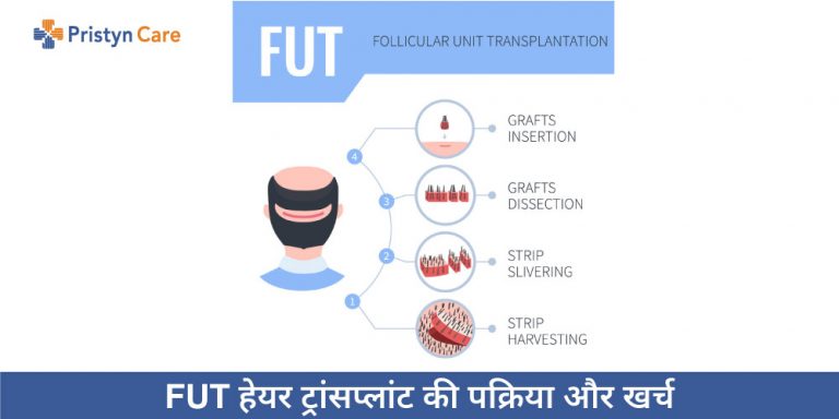 FUT Hair Transplant in Hindi